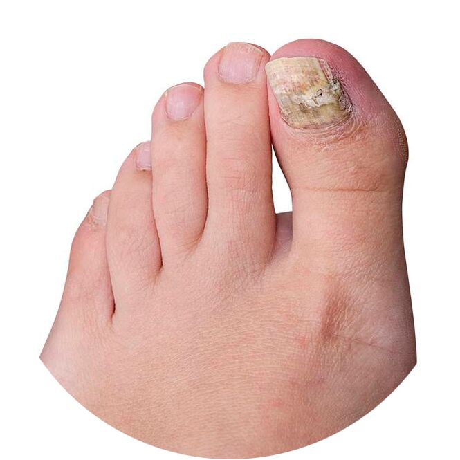 Promicil cream for fungal infection on the toes