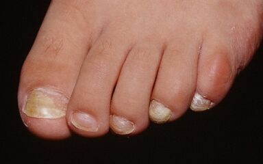 Reasons for appearing the fungus on the big toe