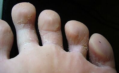 How does the fungus look like and how to treat it