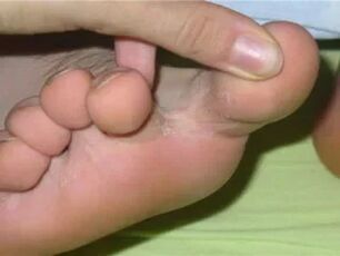 Itching of fingers