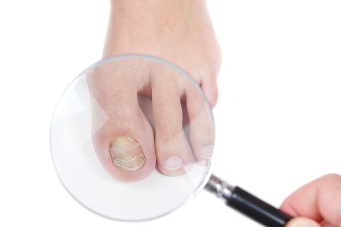 A nail affected by the fungus under a magnifying glass