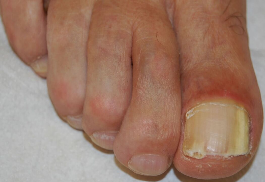 Distal-lateral subungual onychomycosis in the foot